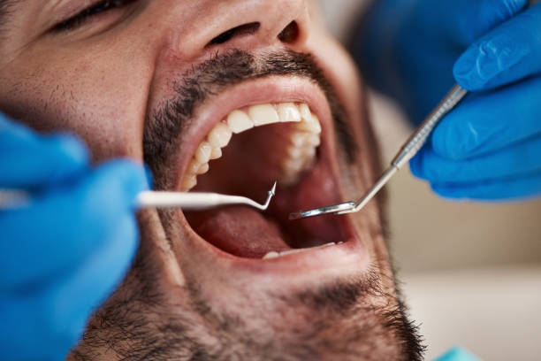 Best Emergency Dentist for Lost Fillings or Crowns in Cherry Hill Mall, NJ